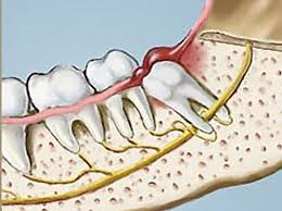 Estrazione denti del giudizio