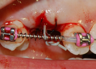 Scappucciamento di un dente