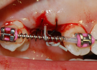 Scappucciamento di un dente