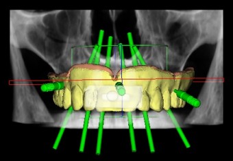 Implantologia guidata computer assistita