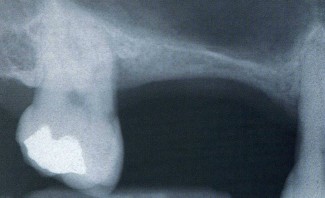 Grande rialzo del seno mascellare