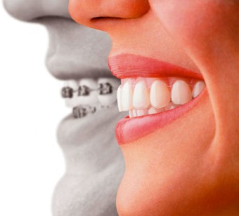 Invisalign